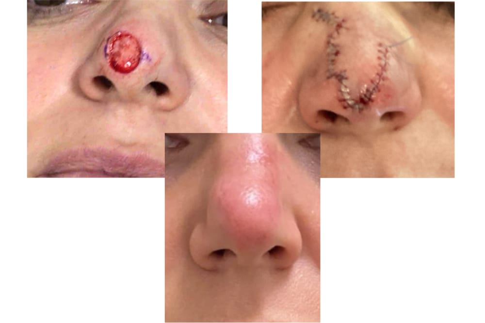 Mohs surgery results